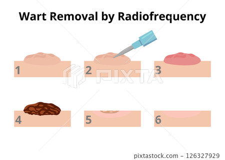 Wart removal by radiofrequency surgery Wart removal by radiofrequency surgery 126327929