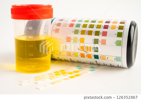 Urinalysis, urine cup with reagent strip pH paper test and comparison chart in laboratory. Urinalysis, urine cup with reagent strip pH paper test and comparison chart in laboratory. 126352867