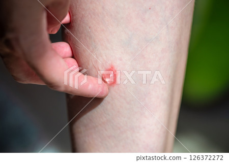 A bright bite from an insect on a person's leg, lubricated with a transparent bite gel, ointment after bites 126372272