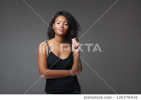 Young woman with vitiligo poses confidently in Young woman with vitiligo poses confidently in 126376426