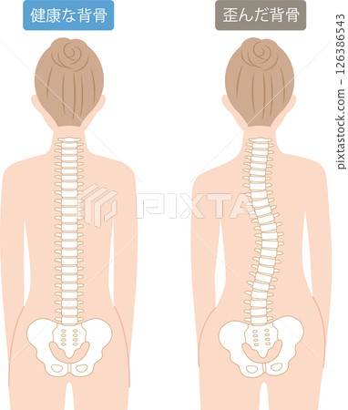 Distorted spine and healthy spine: Woman's back view 126386543