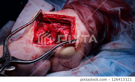 Surgical retractors spreading wide leg incision, exposing raw bone and tissue during intricate medical intervention Surgical retractors spreading wide leg incision, exposing raw bone and tissue during intricate medical intervention 126413321