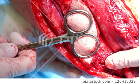 Sterile surgical field revealing precise knee operation, metallic instruments carefully dissecting connective tissues during intricate orthopedic intervention Sterile surgical field revealing precise knee operation, metallic instruments carefully dissecting connective tissues during intricate orthopedic intervention 126413322