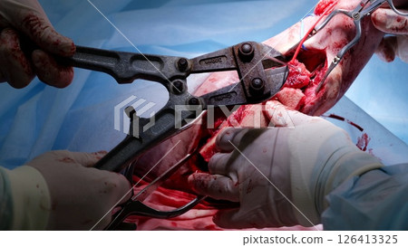 Surgical team performing intricate medical procedure, using precise instruments while carefully operating in sterile hospital operating room Surgical team performing intricate medical procedure, using precise instruments while carefully operating in sterile hospital operating room 126413325