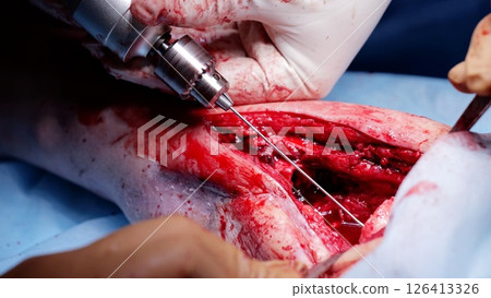 Medical professionals are meticulously operating on a patient's leg, employing surgical instruments with precision and care during a critical procedure Medical professionals are meticulously operating on a patient's leg, employing surgical instruments with precision and care during a critical procedure 126413326