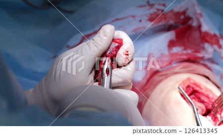 Close up of gloved hands holding surgical pliers and manipulating tissue during a complex surgical procedure, highlighting precision and focus in a life saving intervention 126413345