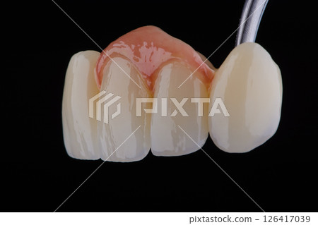 Naturally dental bridge with artificial gum made of zirconium for fixation to frontal upper teeth. Naturally dental bridge with artificial gum made of zirconium for fixation to frontal upper teeth. 126417039