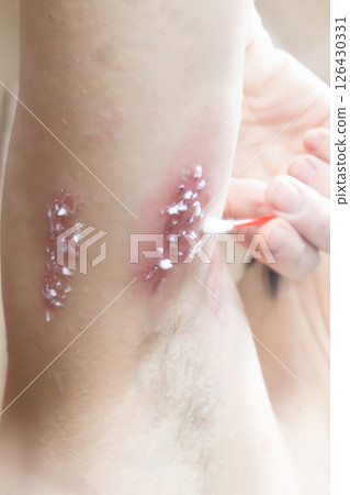 Woman with shingles on the skin she feels very painful Woman with shingles on the skin she feels very painful 126430331