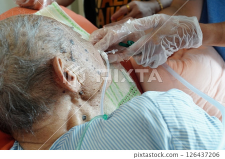Sputum extraction Sputum extraction 126437206