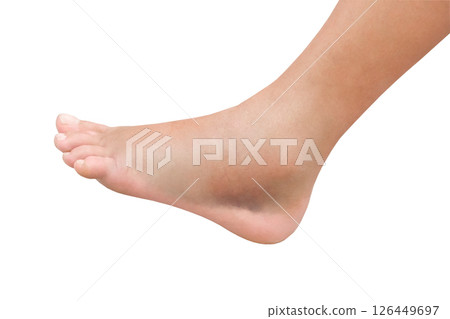 female injured leg with swelling and hematomas, isolated on white background 126449697