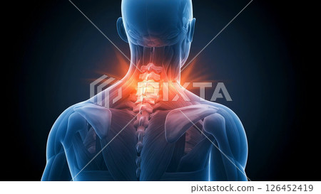 Medical illustration of a man suffering from pain and muscle tension around the neck. Showing the muscle structure of the human body and highlighting inflammation and injury. 126452419
