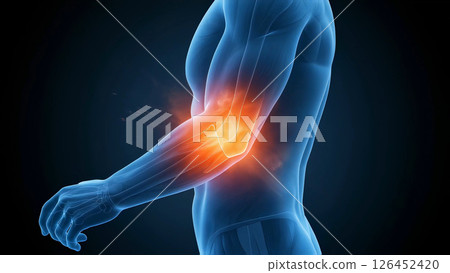 Medical illustration of a man facing left with elbow pain and muscle tension. Showing the muscle structure of the human body and highlighting inflammation and injury 126452420