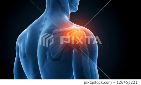 Medical illustration of a man suffering from shoulder joint pain and muscle tension, showing human muscle anatomy to highlight inflammation and injury 126453221
