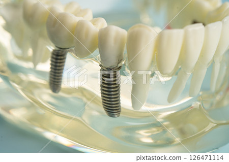 Dental implant, artificial tooth roots into jaw, root canal of dental treatment, gum disease, teeth model for dentist studying about dentistry. 126471114
