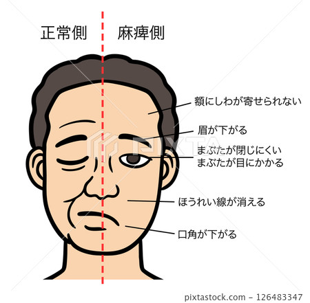 A man with facial paralysis closing his eyes, comparing the normal side with the paralyzed side 126483347