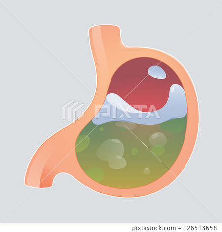 Cartoon image of liquid medicine easing acid reflux or reducing stomach acid. 126513658