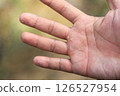 Hand Eczema on man hand with selective focus from being allergic reactions some chemical  oxidant 126527954
