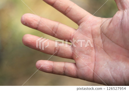 Hand Eczema on man hand with selective focus from being allergic reactions some chemical oxidant Hand Eczema on man hand with selective focus from being allergic reactions some chemical oxidant 126527954