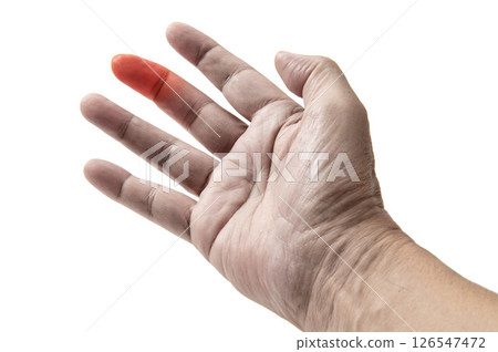 Heberden's nodes on a man's middle finger Heberden's nodes on a man's middle finger 126547472