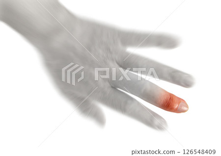 男人中指上的赫伯登結節 男人中指上的赫伯登結節 126548409