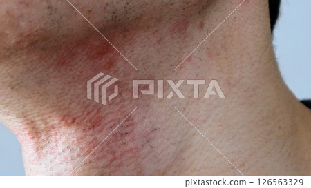 Japanese man with rough skin after shaving 126563329