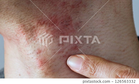 Man pointing at skin inflammation after beard shaving 126563332