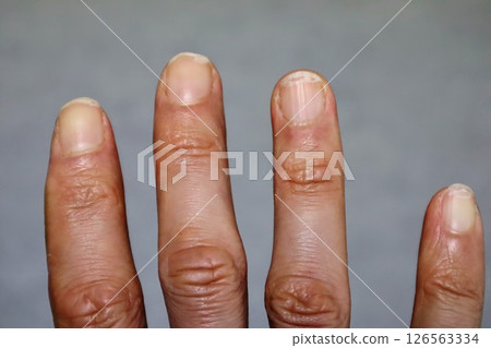 指甲受傷的手的特寫 指甲受傷的手的特寫 126563334