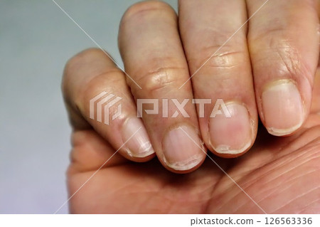 手指甲受傷 手指甲受傷 126563336