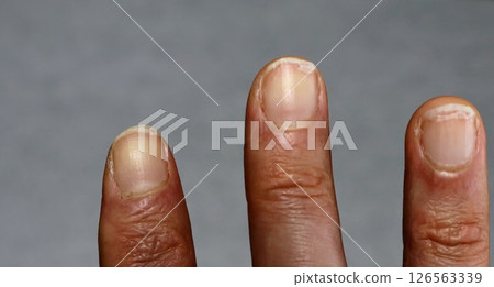 破裂的指甲特寫 126563339