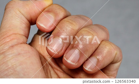 指甲受傷的手的特寫 126563340
