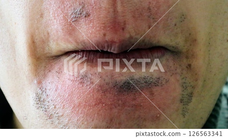 A Japanese man who had some hair removed but still had some facial hair 126563341