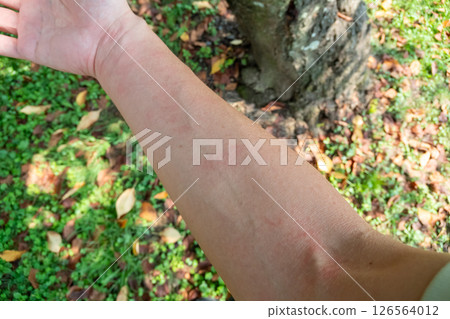 A middle-aged man who develops hives while doing outdoor leisure activities A middle-aged man who develops hives while doing outdoor leisure activities 126564012