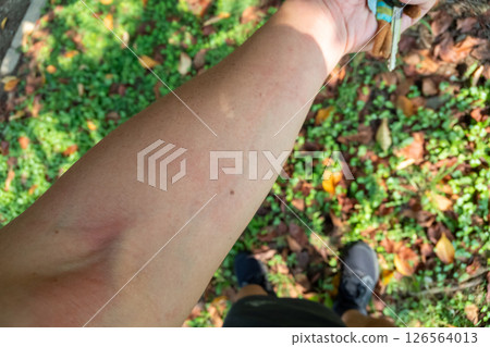 一名中年男子進行戶外休閒活動時出現蕁麻疹 126564013