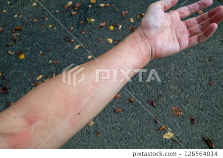 Middle-aged man with hives on his arm Middle-aged man with hives on his arm 126564014