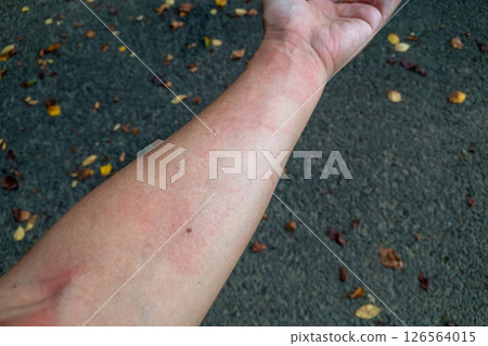 Middle-aged man with hives on his arm 126564015