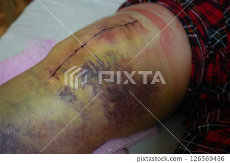 Postoperative suture on woman's leg. Closeup of scar after knee fracture. Traces of interrupted sutures leg after surgery. Recovery and wound healing concept 126569486