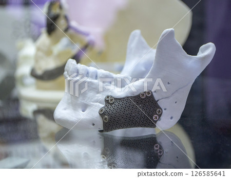 Prototype of lower human jaw with medical titanium implant from biocompatible titanium printed on 3D printer. Maxillo-facial prosthesis anatomical human bone from metal powder. 3D printing technology 126585641