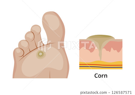 Corn on the sole of the foot and its anatomical structure 126587571