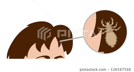 Magnifying glass showing head louse attached to hair on persons head Magnifying glass showing head louse attached to hair on persons head 126587588