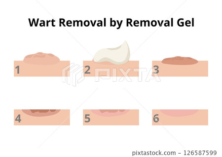 Wart removal process using a removal gel Wart removal process using a removal gel 126587599