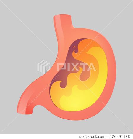 Acid reflux or heartburn 126591178
