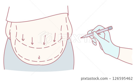 Illustration of various Abdomen Procedures, focusing on aesthetics, anatomy, and related art Illustration of various Abdomen Procedures, focusing on aesthetics, anatomy, and related art 126595462