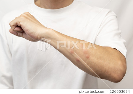 Man's arm bitten by insects 126603654