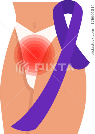 Gynecologic cancer awareness month. Gynecological disease illustration. Adnexal tumor 126605814