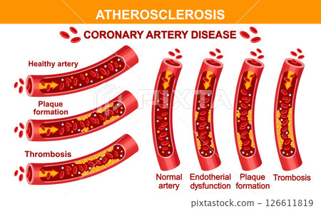 Atherosclerosis coronary artery disease, block arterial vessel cholesterol plaque, blood pressure, heart organ health. Cardiac cardiovascular system vascular thrombosis. Hypertension treatment vector 126611819
