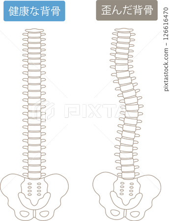 A crooked spine and a healthy spine 126616470