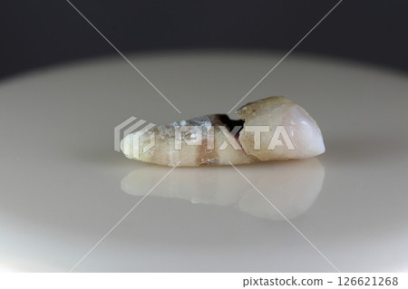 A sick, damaged human tooth. 126621268