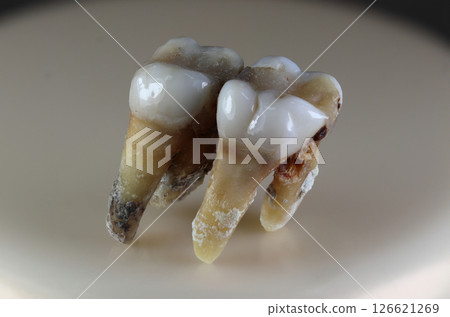 A sick, damaged human tooth. 126621269