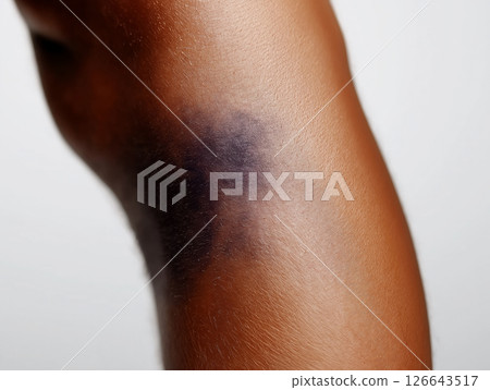 Close-up of a human leg with a large dark purple bruise Close-up of a human leg with a large dark purple bruise 126643517