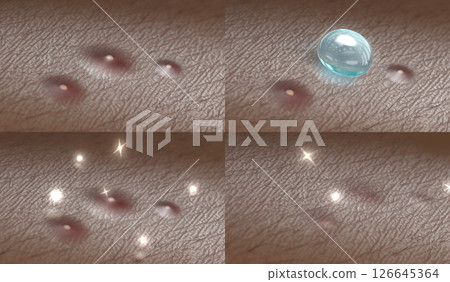 Skin surface with acne and drop gel treatment macro 126645364